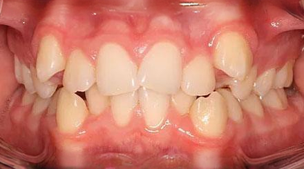 Before treatment - patient 54