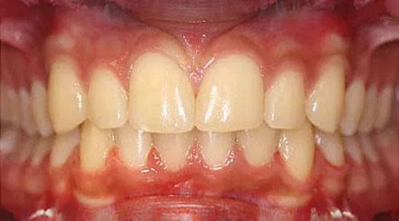 After treatment - patient 55