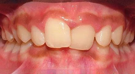 Before treatment - patient 55