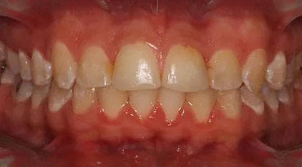 After treatment - patient 56
