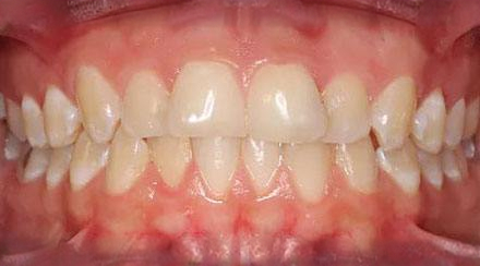 Before treatment - patient 56