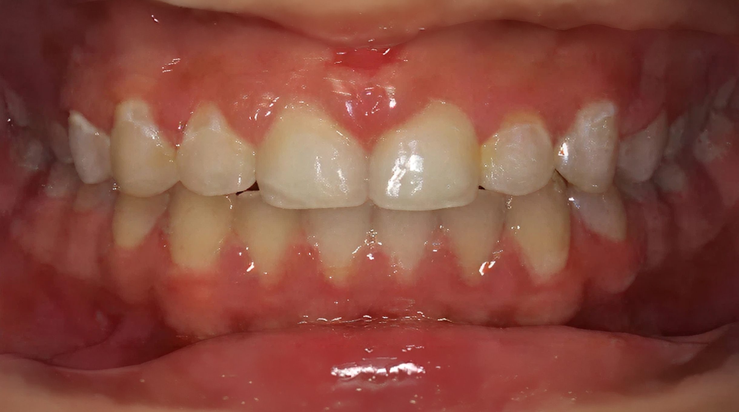 After treatment - patient 57
