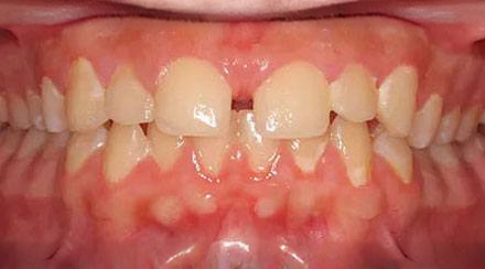 Before treatment - patient 57