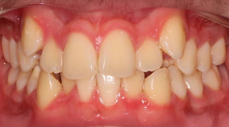 Before treatment - patient 8
