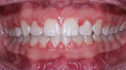 After treatment - patient 58