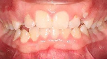 Before treatment - patient 58
