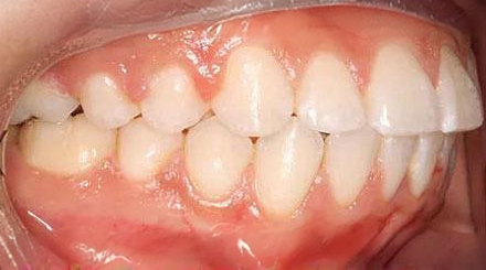 After treatment - patient 60