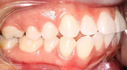 Before treatment - patient 60