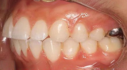 After treatment - patient 61