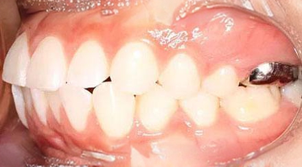 Before treatment - patient 61
