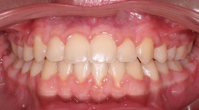 After treatment - patient 20