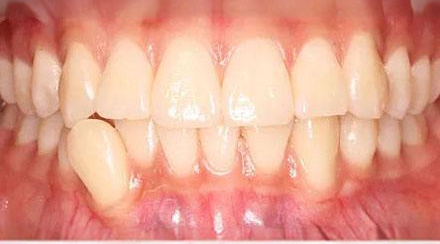 After treatment - patient 62
