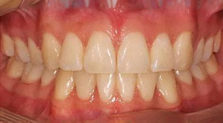 Before treatment - patient 62