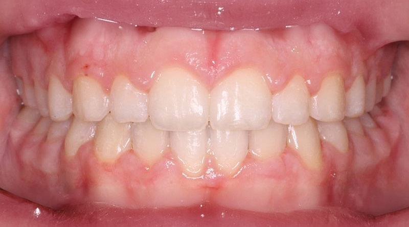 After treatment - patient 22