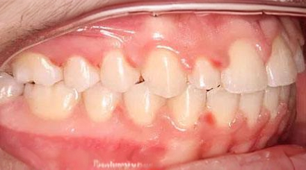 After treatment - patient 64