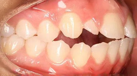 Before treatment - patient 64