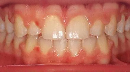 After treatment - patient 65