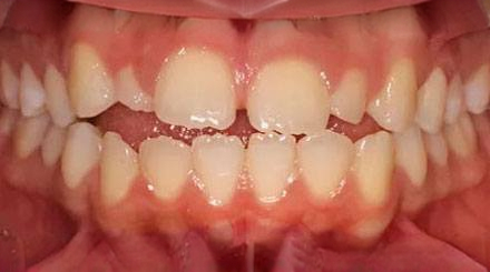 Before treatment - patient 65