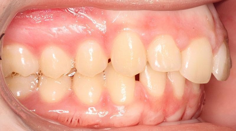 Before treatment - patient 15