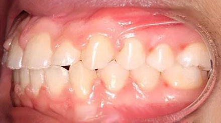After treatment - patient 66
