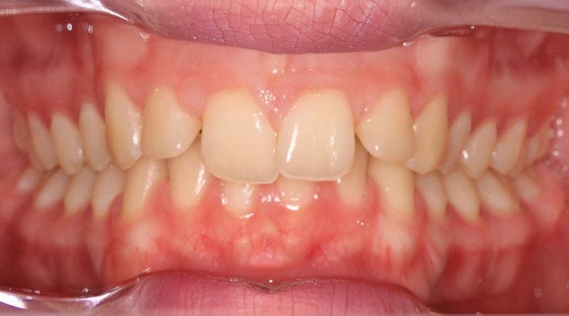 Before treatment - patient 14