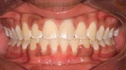 After treatment - patient 68