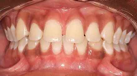 Before treatment - patient 68