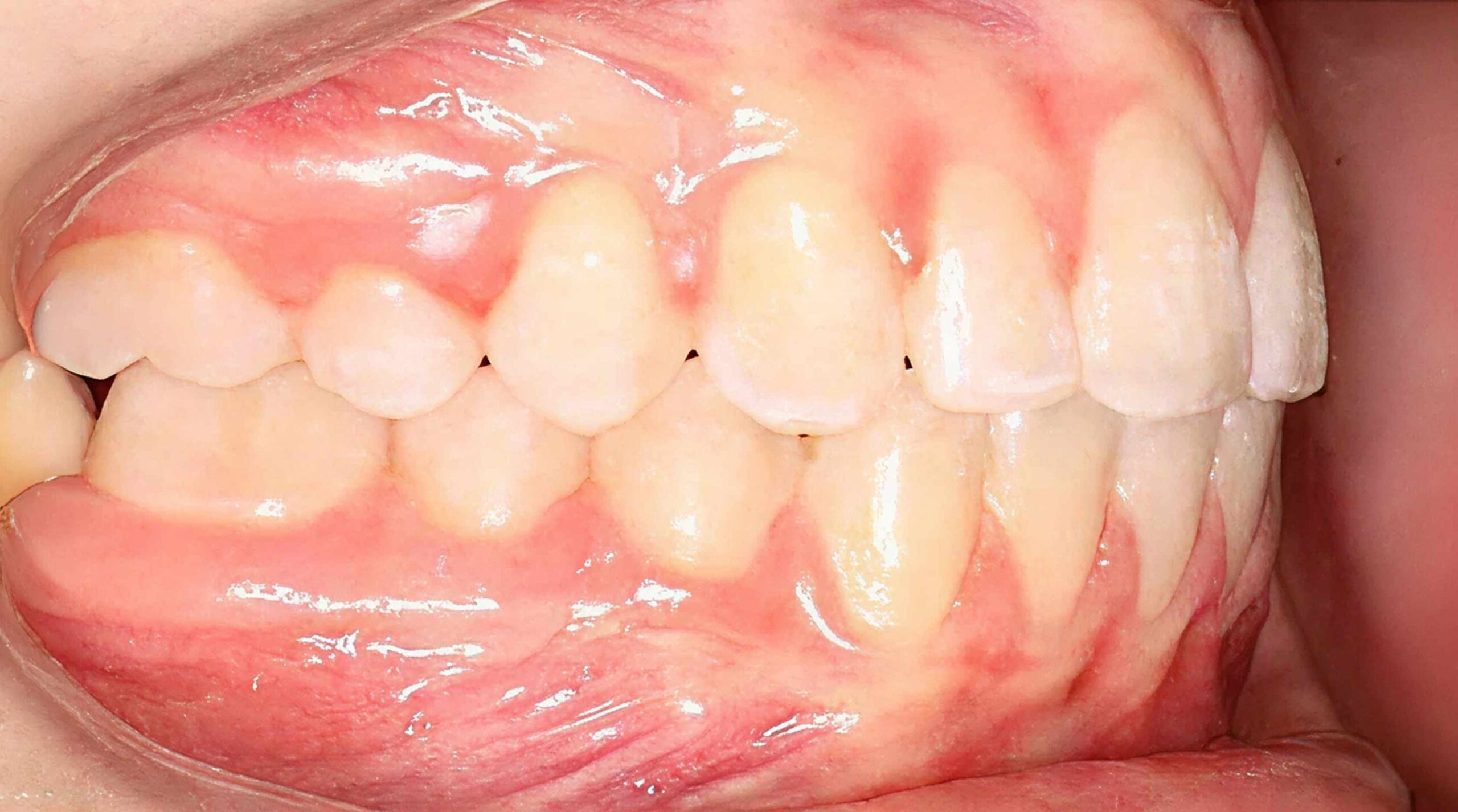 After treatment - patient 69