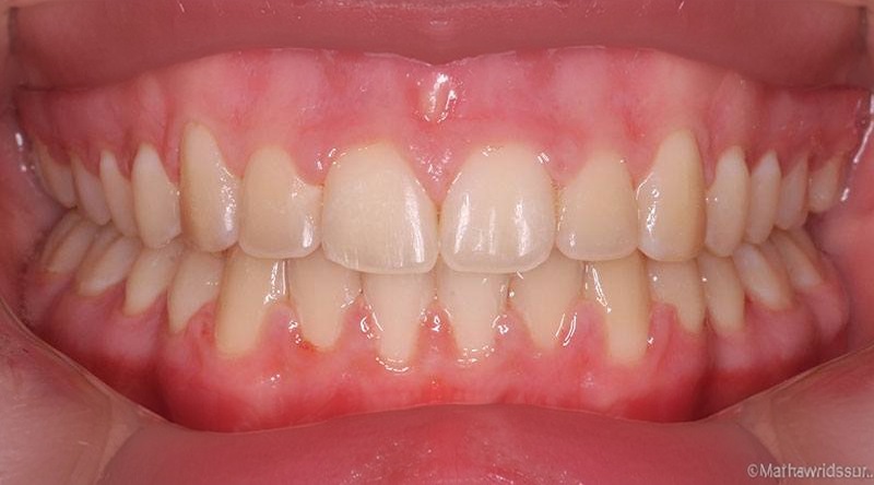 After treatment - patient 14