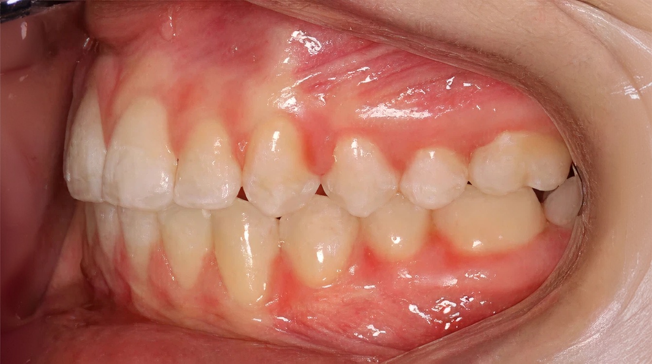 After treatment - patient 70