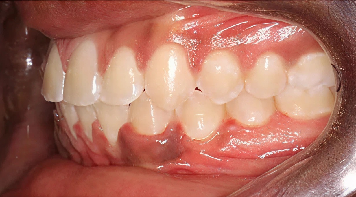 After treatment - patient 71