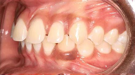 Before treatment - patient 71