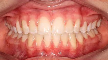After treatment - patient 72