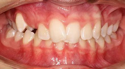 Before treatment - patient 72