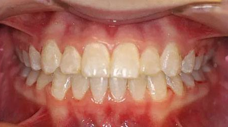 After treatment - patient 74