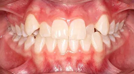 Before treatment - patient 74