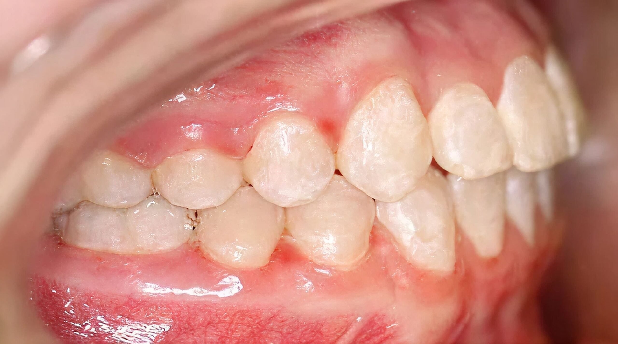 After treatment - patient 75