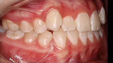 Before treatment - patient 75