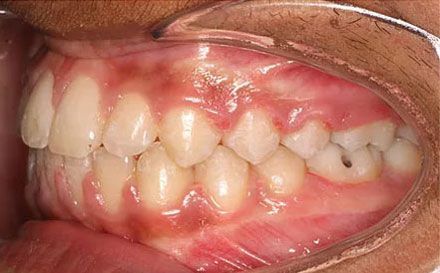 After treatment - patient 76
