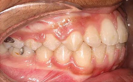 After treatment - patient 77