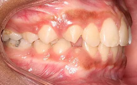 Before treatment - patient 77