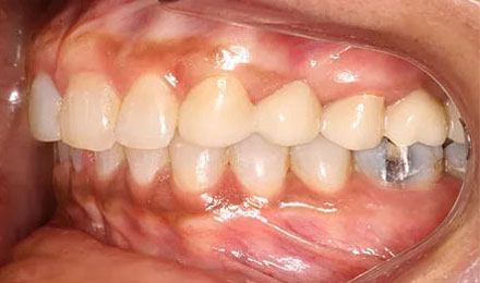 After treatment - patient 78