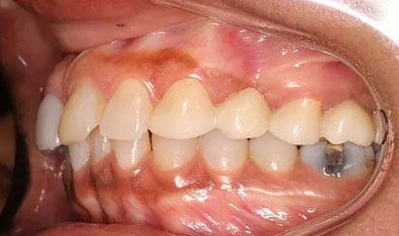 Before treatment - patient 78