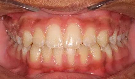 After treatment - patient 79