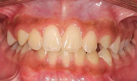 Before treatment - patient 79