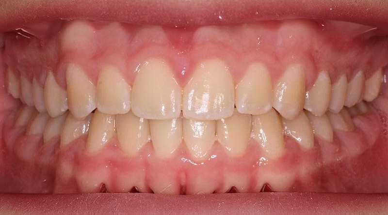 After treatment - patient 13