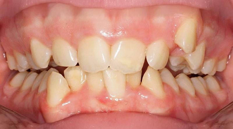 Before treatment - patient 33