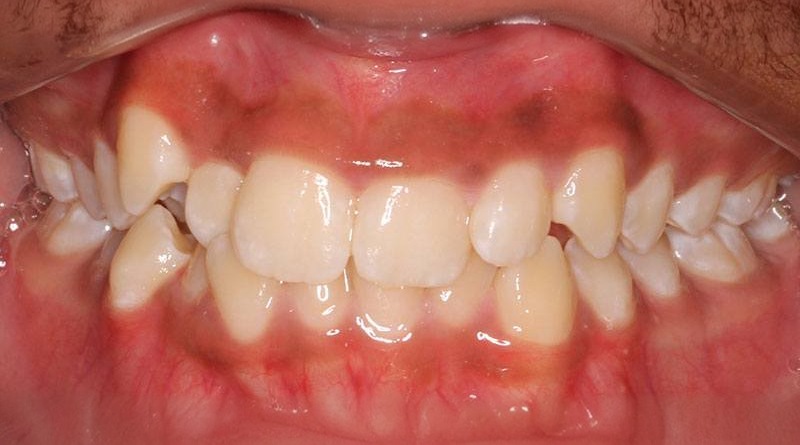After treatment - patient 32