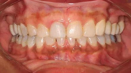After treatment - patient 80