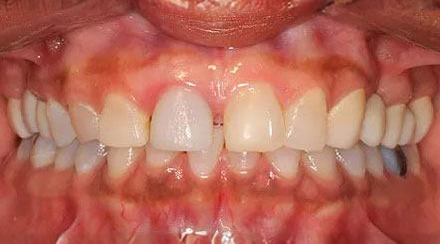 Before treatment - patient 80